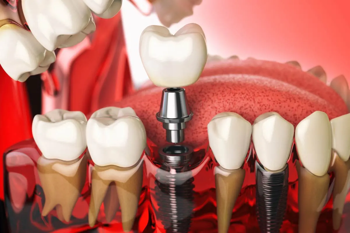 3D model showing how dental implants work