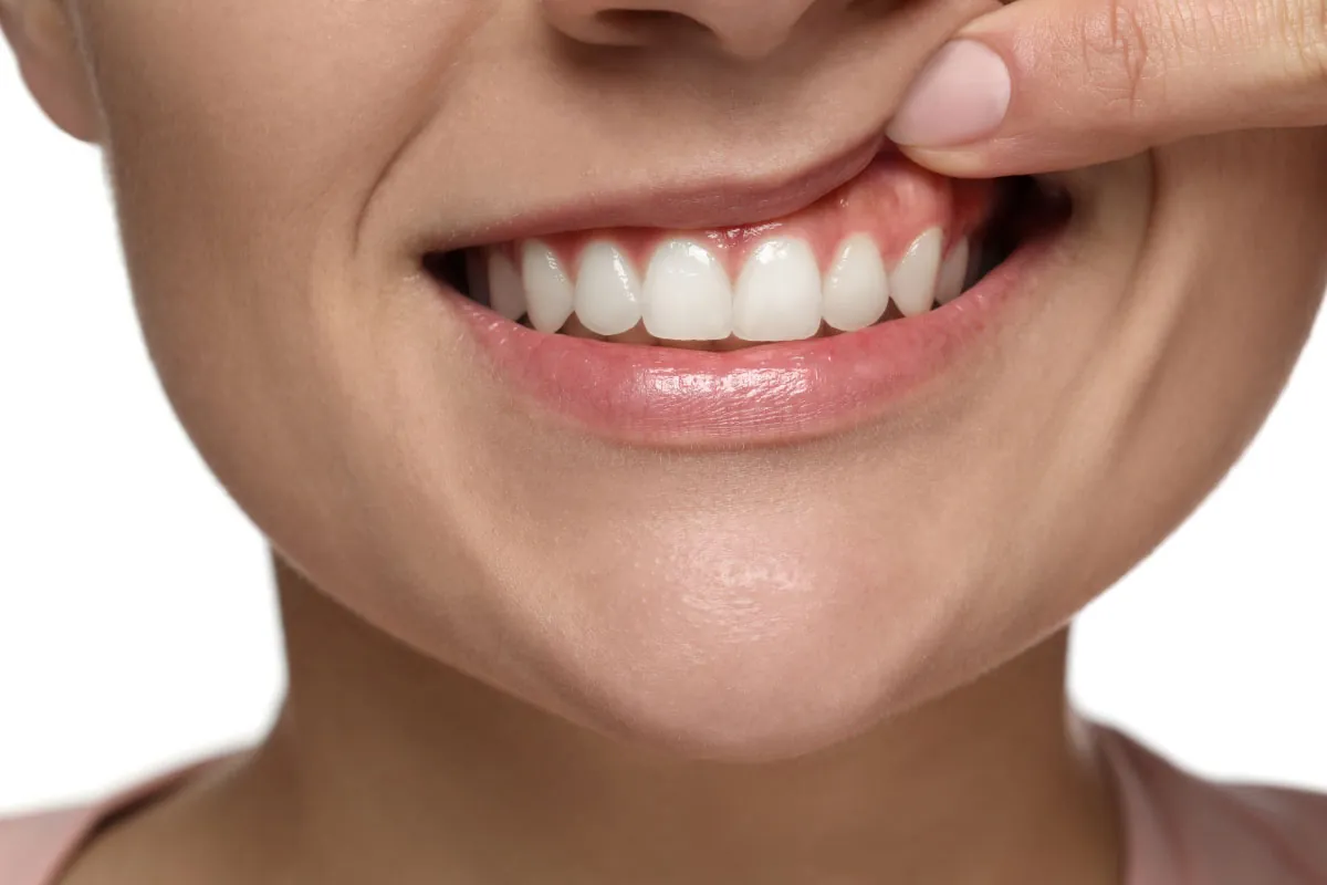 closeup of a woman's smile after an emergency dentist appointment at Ellinwood Dental Care in Fort Wayne, IN